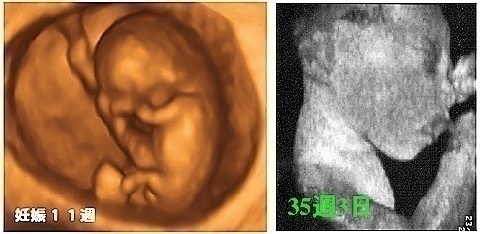 3次元4次元超音波診断装置を駆使した胎児発育の評価、胎児診断
