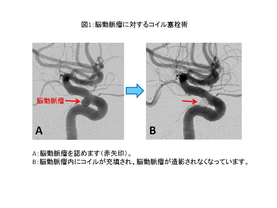 脳 動脈 瘤 手術