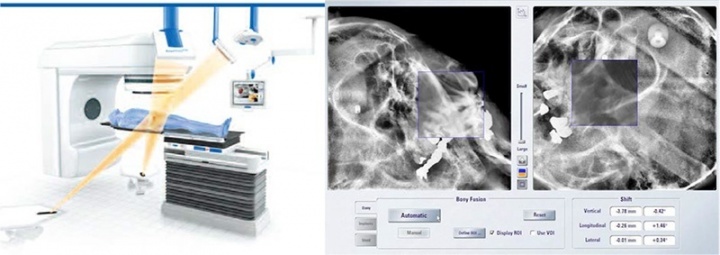 画像誘導放射線治療