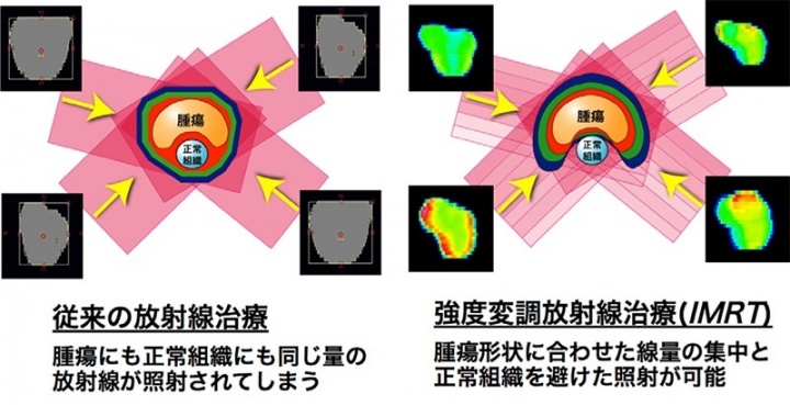 強度変調放射線治療(IMRT)