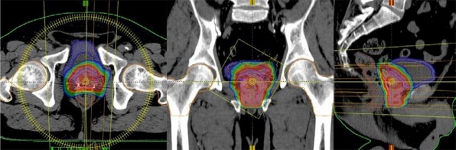 前立腺癌に対するIMRTの線量分布